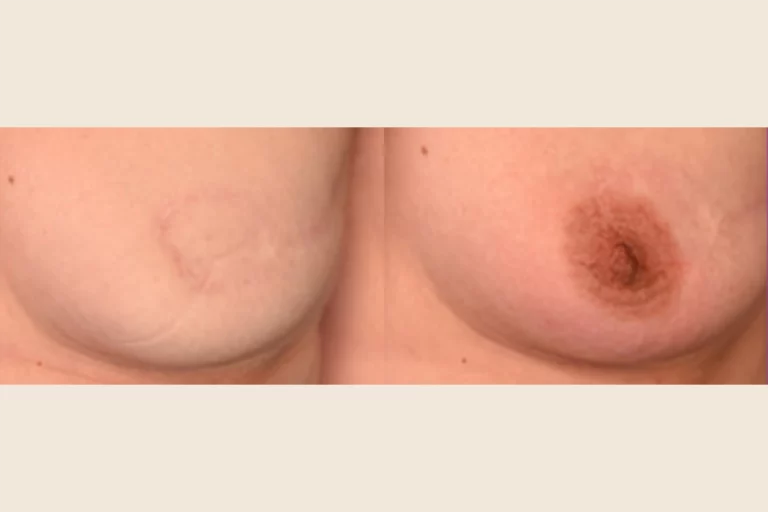 This is a medical indication following breast reconstruction.