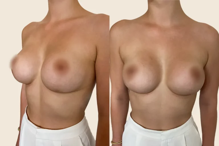 This is an aesthetic procedure. You can see the before picture during your consultation in our practice.