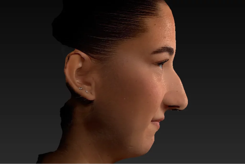 3D-Simulation der Nase einer Patientin des realen Zustands vor der OP.