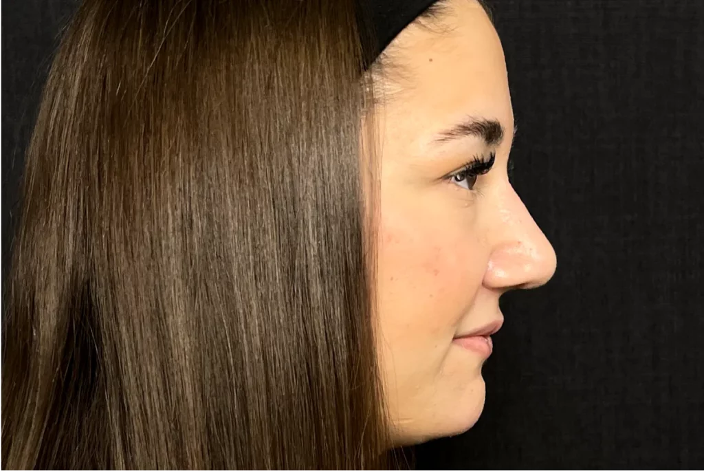 Profilaufnahme einer Patientin mit dem realen Ergebnis 3 Monate nach der Nasen OP.