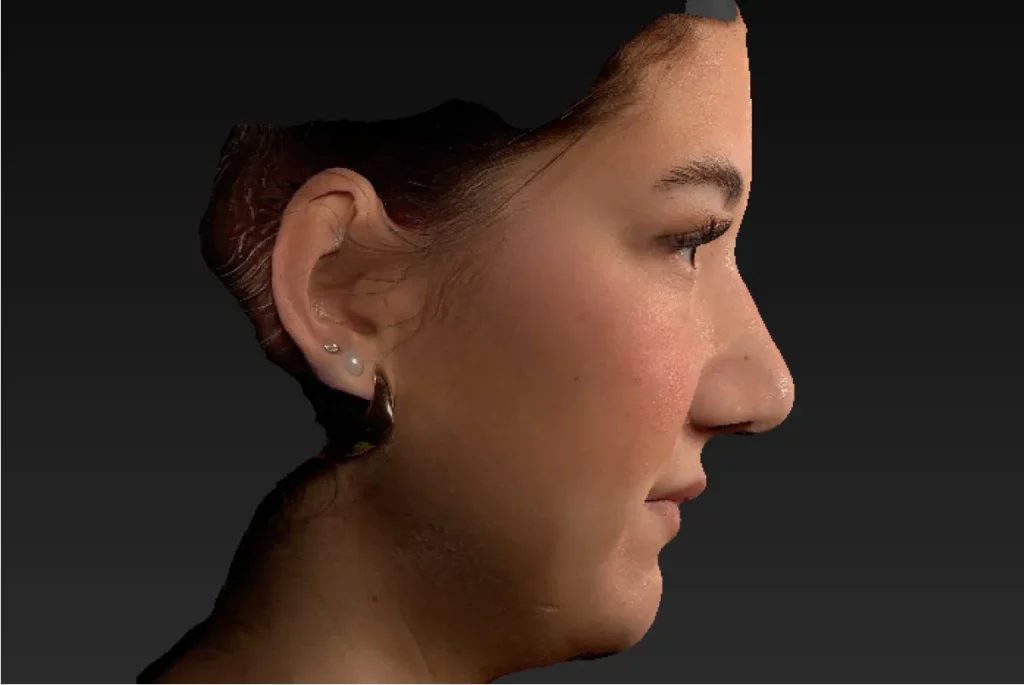 3D-Simulation einer Patientin wie die Nase nach der OP aussehen wird.