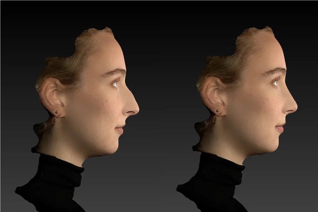 3D-Simulation einer Patientin in der Profilansicht im Vorher-Nachher Vergleich.