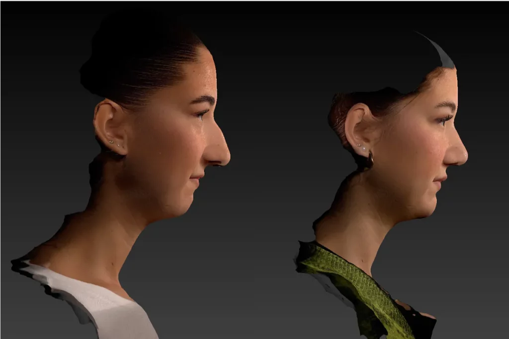3D-Simulation einer Patientin in der Profilansicht im Vorher-Nachher Vergleich.