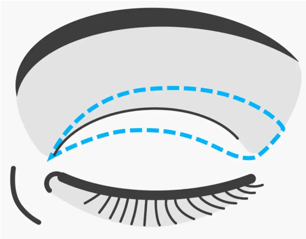 Grafik eines geschlossenen Auges mit angezeichneten Linien für die Schnittführung bei der Oberlidstraffung.