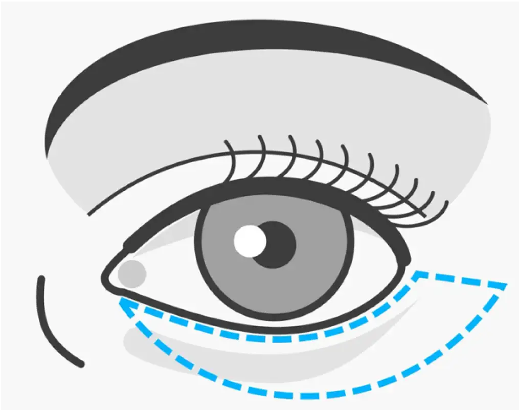 Grafik eines offenen Auges mit angezeichneten Linien für die Schnittführung bei der Unterlidstraffung.