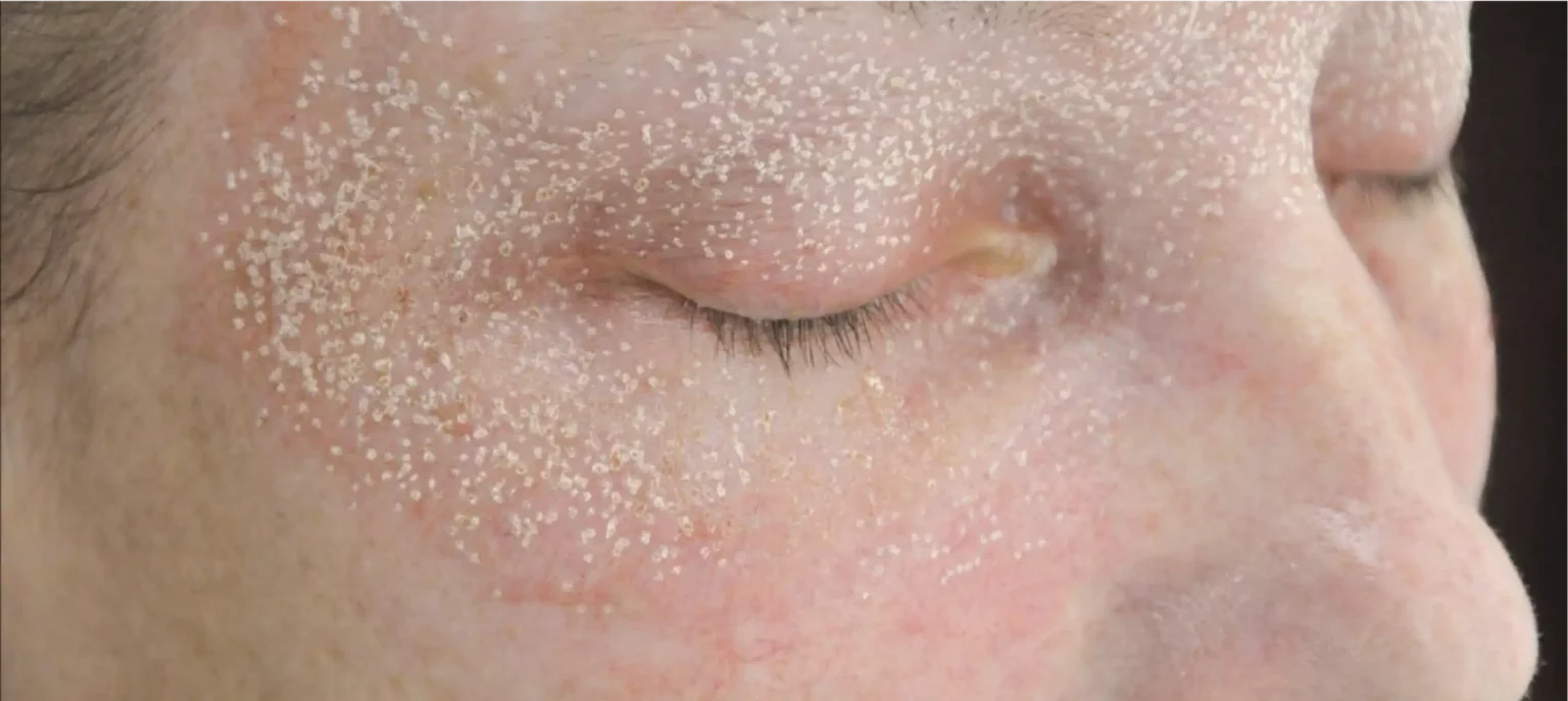 Nahaufnahme von Gesicht nach einer CO2 Faxel Laser Behandlung. Haut leicht gerötet und voller weißer Punkte vom Laser.