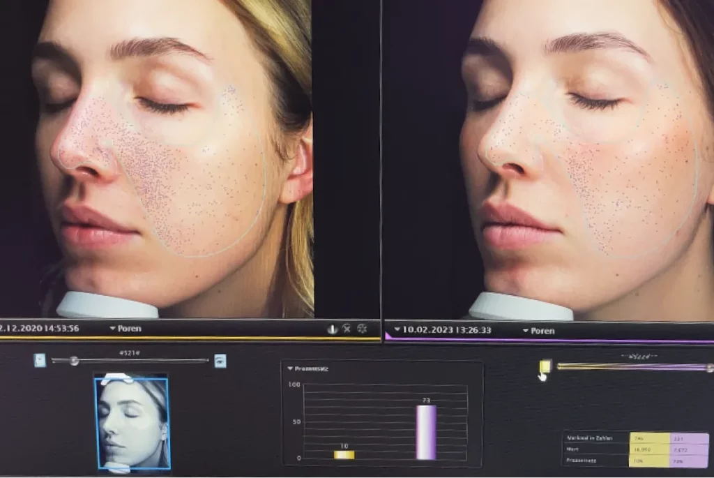 Hautanalyse der Poren einer Patientin im Vergleich. Aufnahmen mit Abstand von über 2 Jahren aufgenommen.