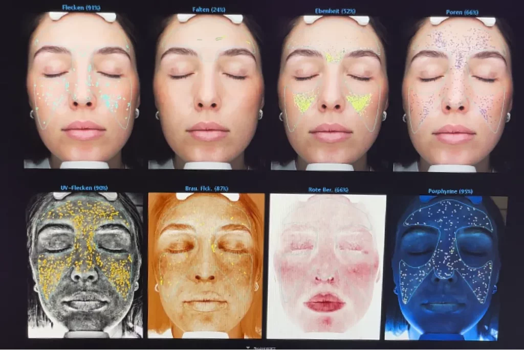 Detailliertes Ergebnis der VISIA Hautanalyse einer Patientin, das zeigt in welchen Bereichen Flecken, Falten, Poren usw. sind.