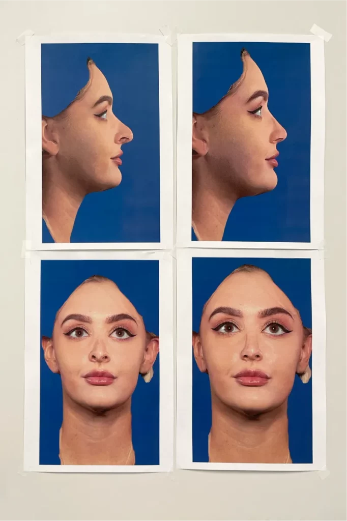 Vier Bilder einer Patientin aus der 3D-Simulation der Nase im Vorher-Nachher Vergleich