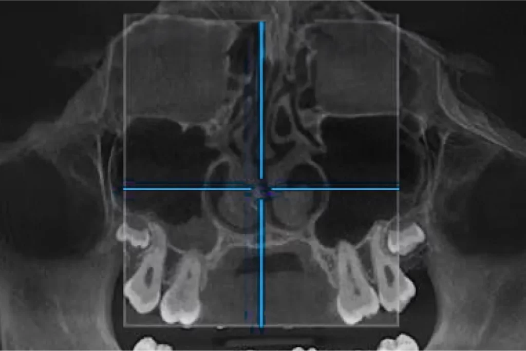 Röntgenaufnahme der Nase.