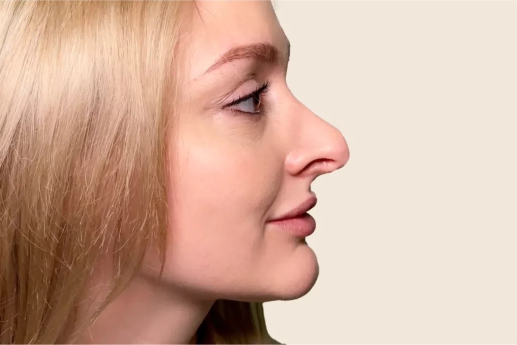 Profilaufnahme einer Patientin vor der Nasen-OP.