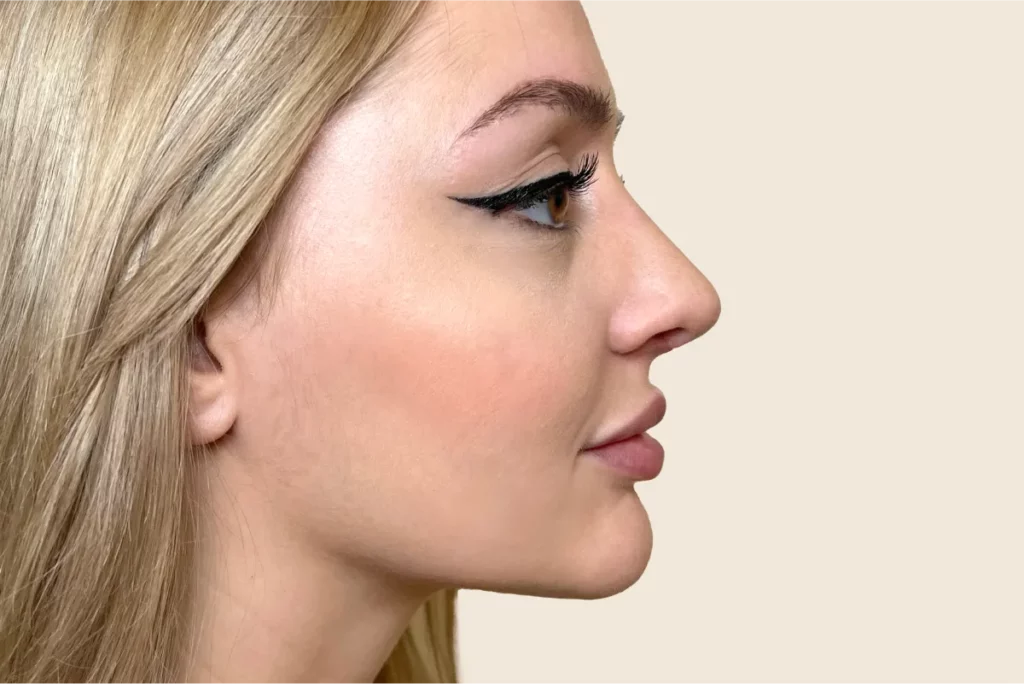 Profilaufnahme einer Patientin nach erfolgreicher Nasen-OP.