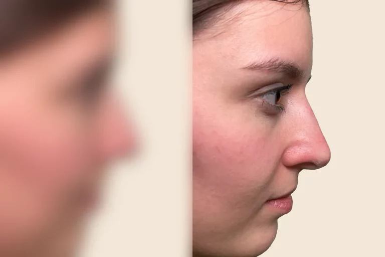 This is an aesthetic procedure. You can see the before picture during your consultation in our practice.