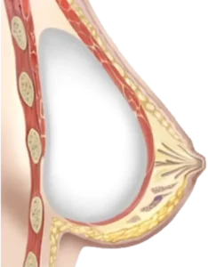 Querschnitt einer Brust mit in dem Brustmuskel platziertem Brustimplantat.